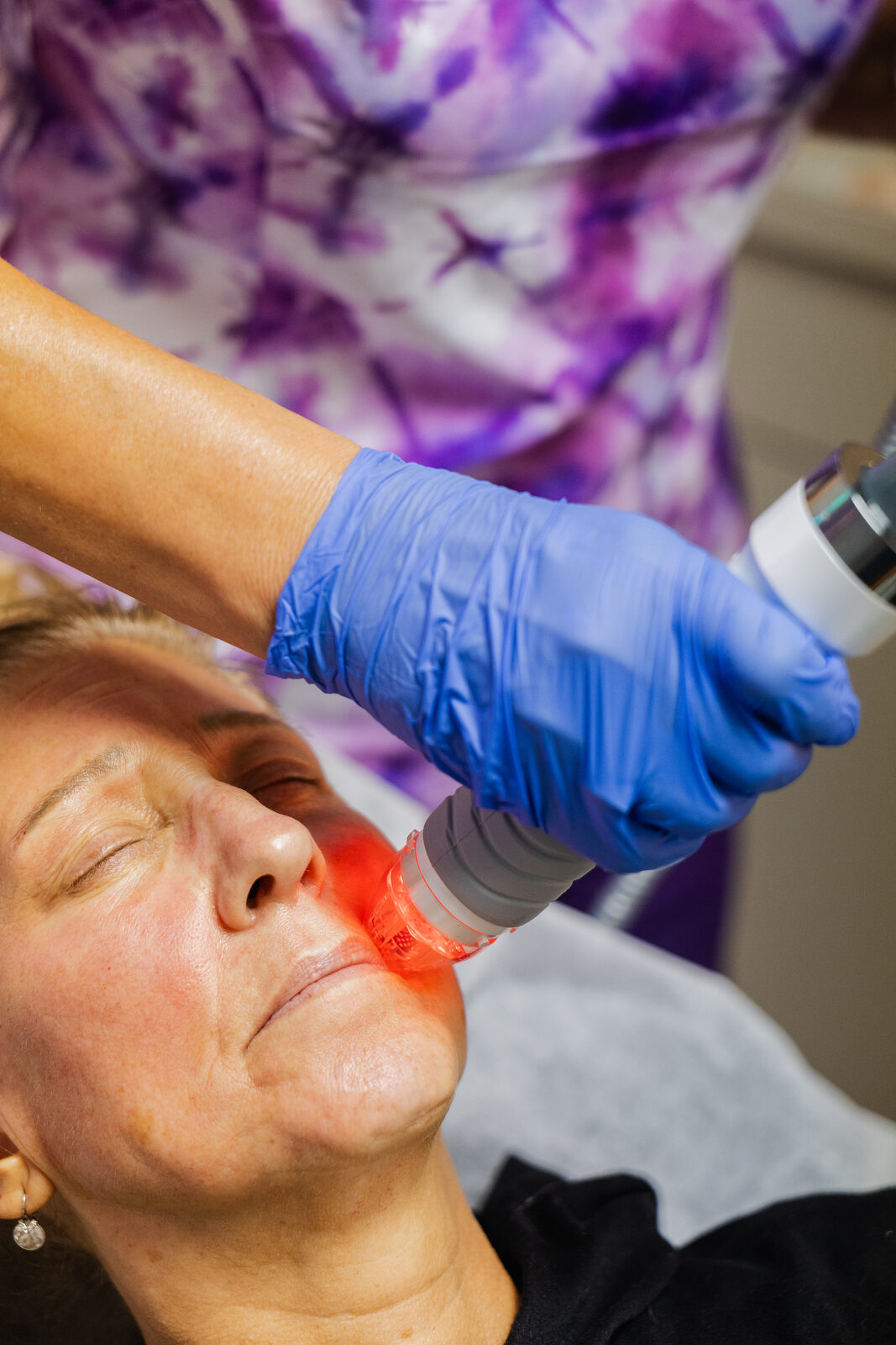 Cutera laser treatment at Skinpoint