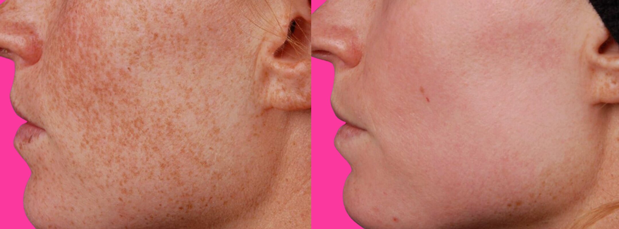 Before and after Nd:YAG treatment showing reduced pigmentation