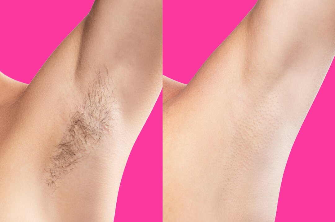 Before and after laser hair removal on underarm